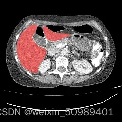 医学图像分割之肝脏分割（2D）
